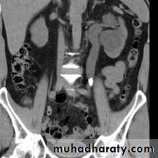 Imaging of urinary tract diseases