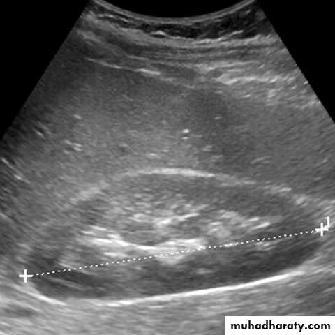 Imaging of urinary tract diseases
