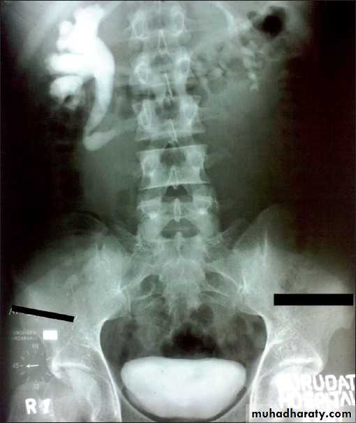 Imaging of urinary tract diseases