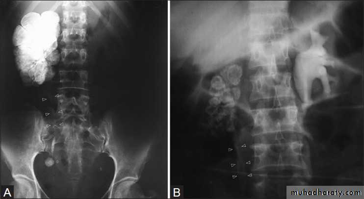 Imaging of urinary tract diseases