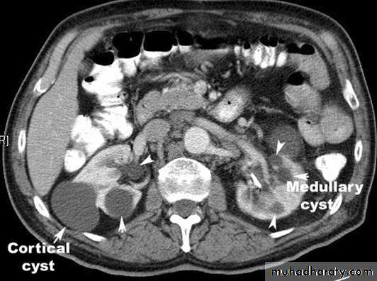 Imaging of urinary tract diseases