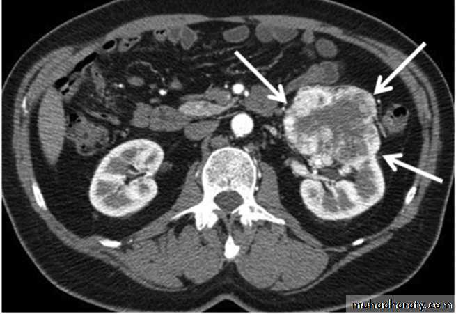 Imaging of urinary tract diseases