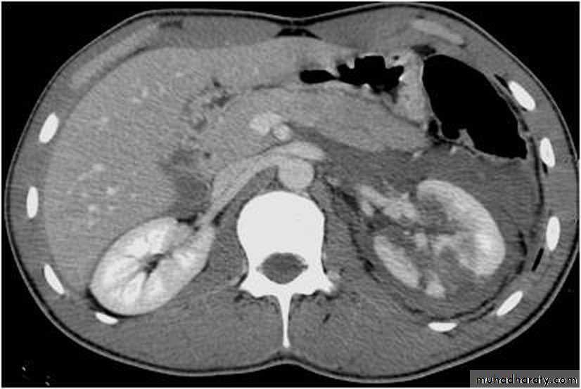 Imaging of urinary tract diseases