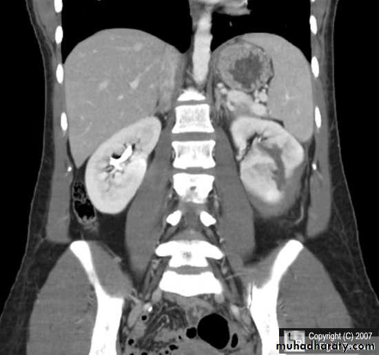 Imaging of urinary tract diseases