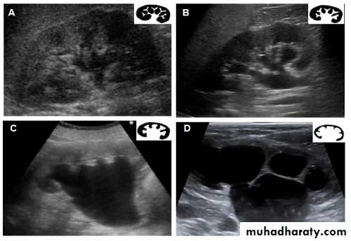 Imaging of urinary tract diseases