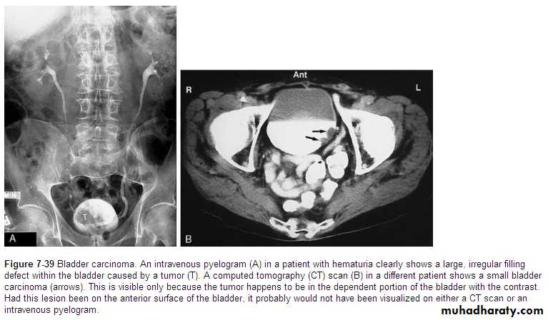 Imaging of urinary tract diseases