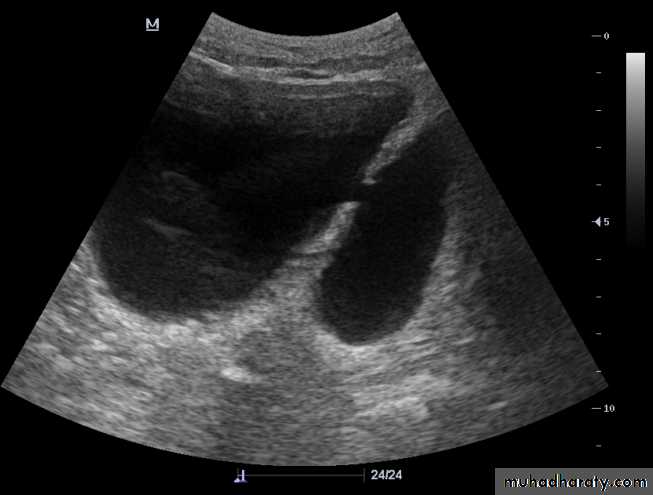 Imaging of urinary tract diseases