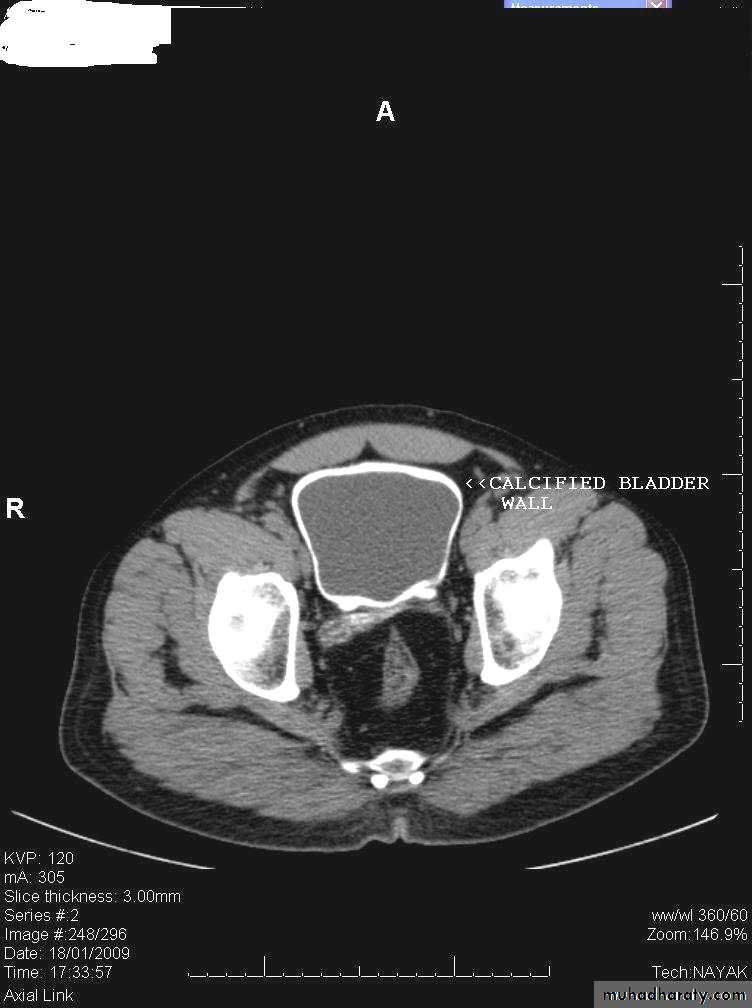Imaging of urinary tract diseases