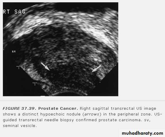 Imaging of urinary tract diseases