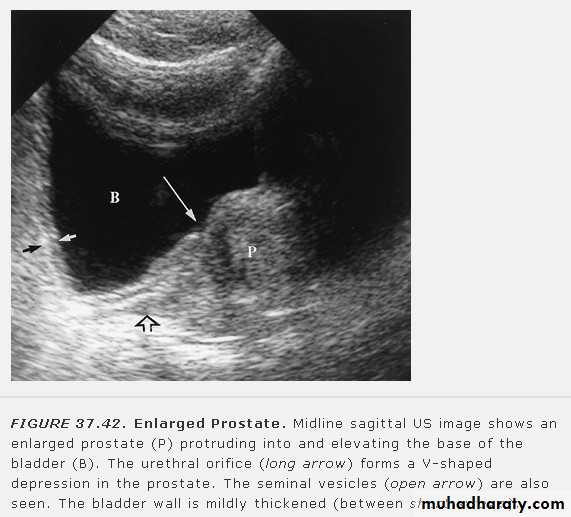 Imaging of urinary tract diseases
