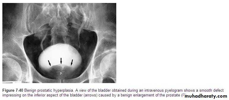 Imaging of urinary tract diseases