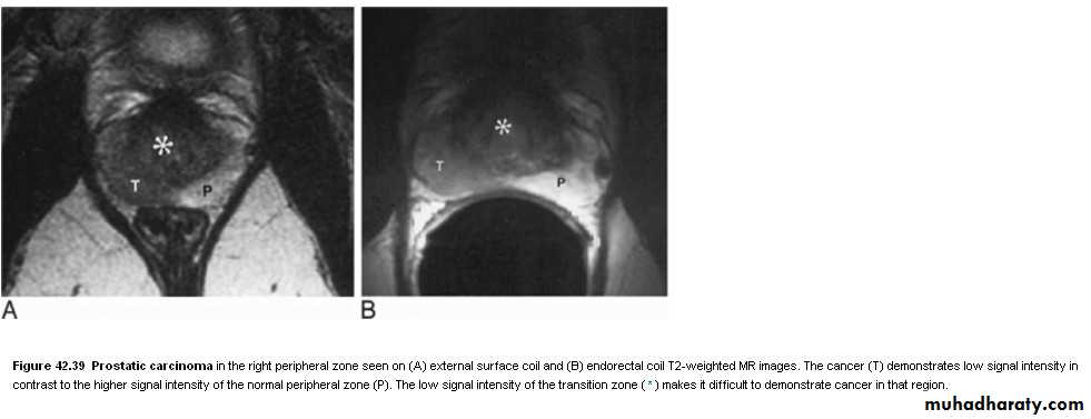 Imaging of urinary tract diseases