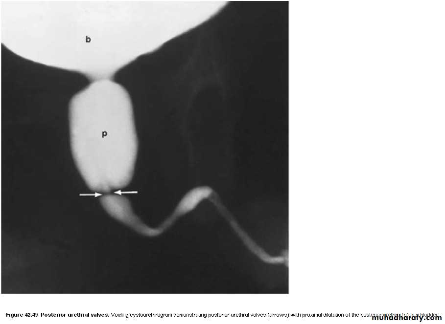 Imaging of urinary tract diseases