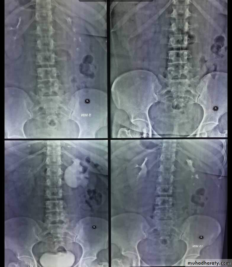 Imaging of urinary tract diseases
