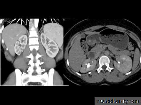 Imaging of urinary tract diseases