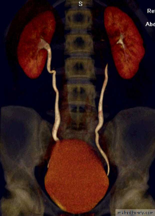 Imaging of urinary tract diseases
