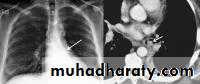 Trachea and bronchi