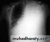 Trachea and bronchi
