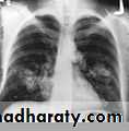 Trachea and bronchi