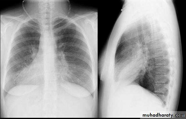 Trachea and bronchi