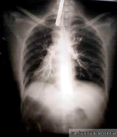 Trachea and bronchi