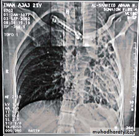 Trachea and bronchi