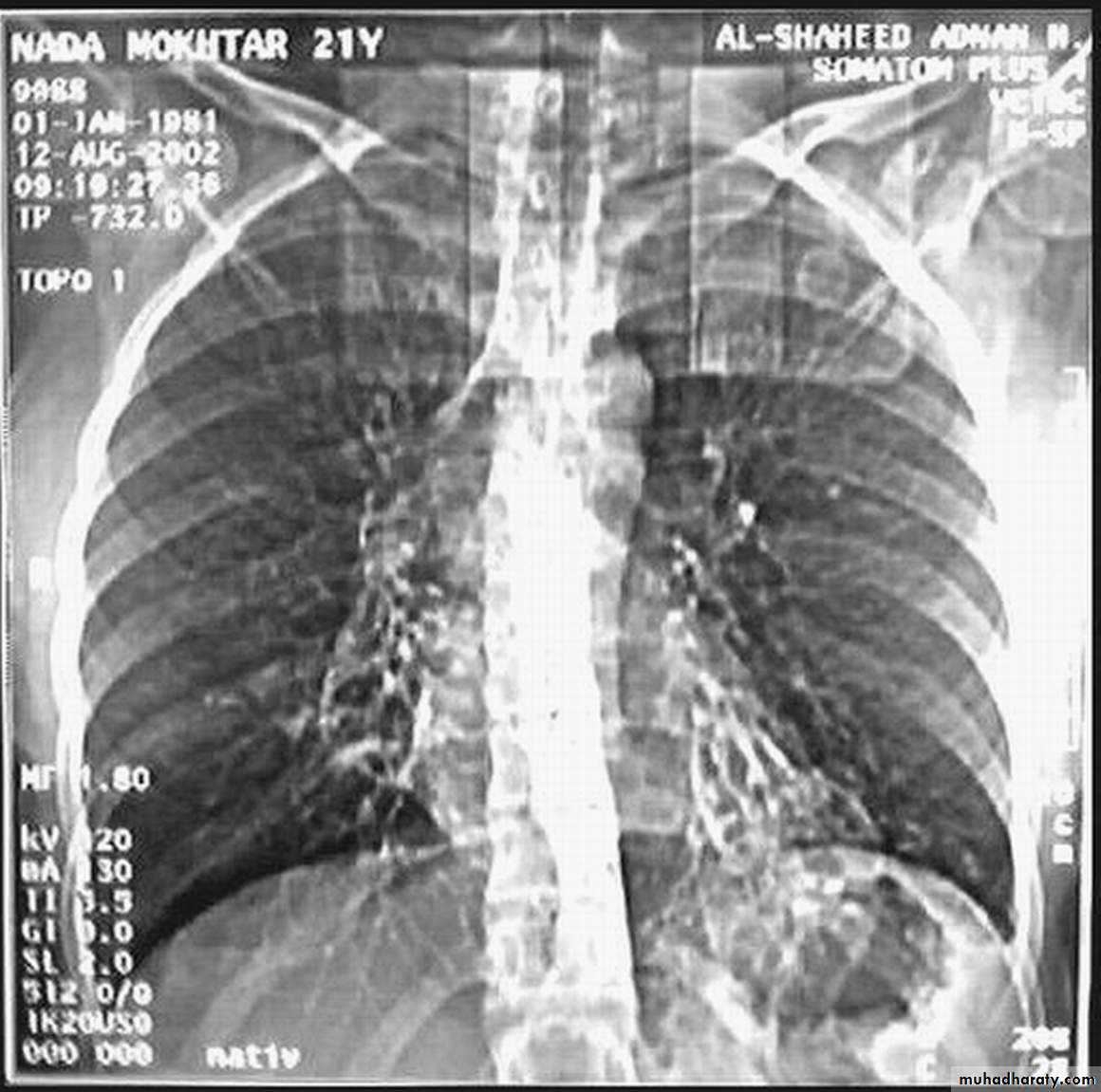 Trachea and bronchi