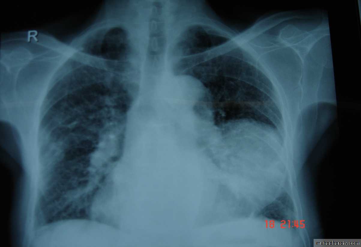 Trachea and bronchi