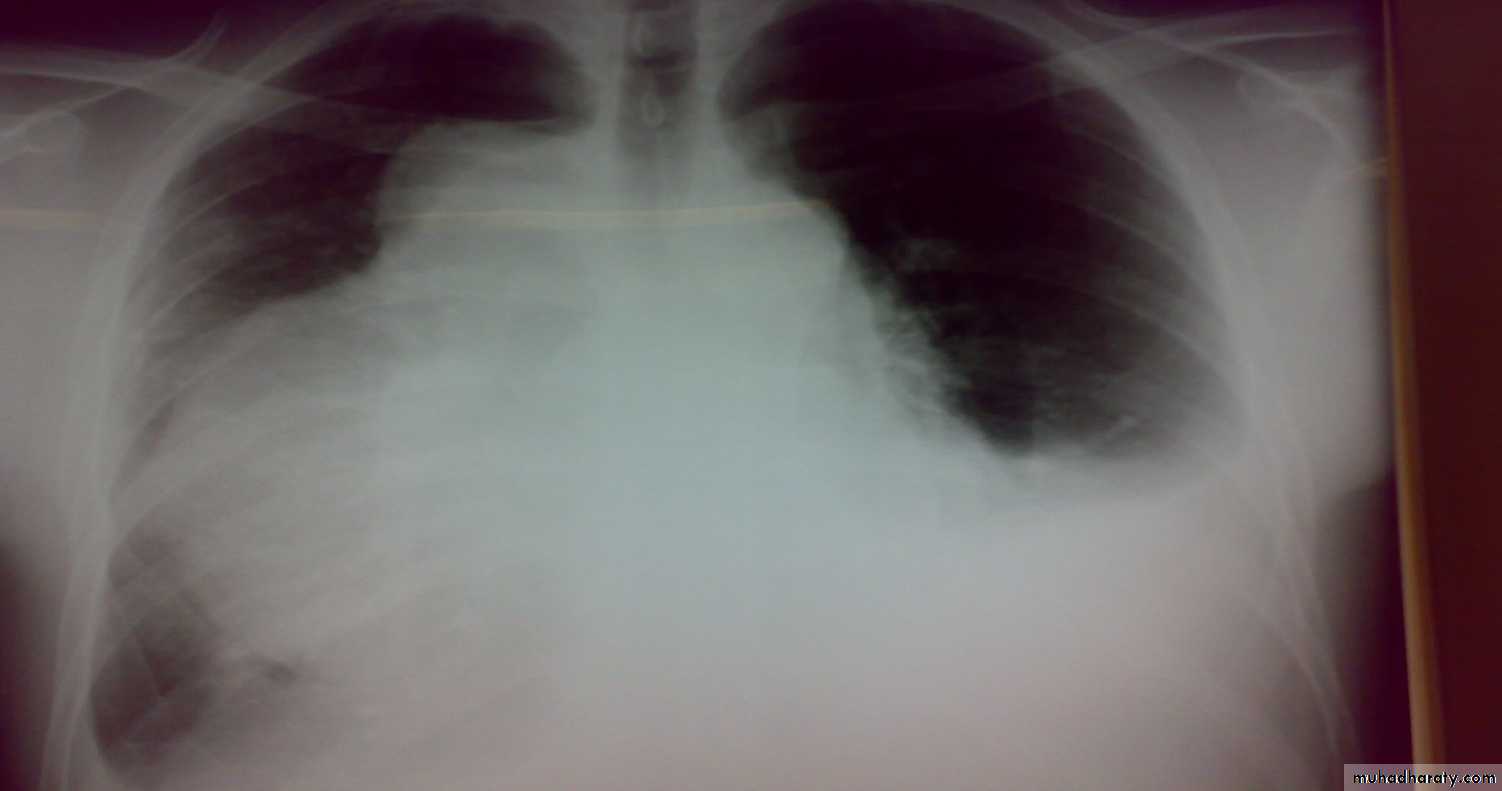 Trachea and bronchi