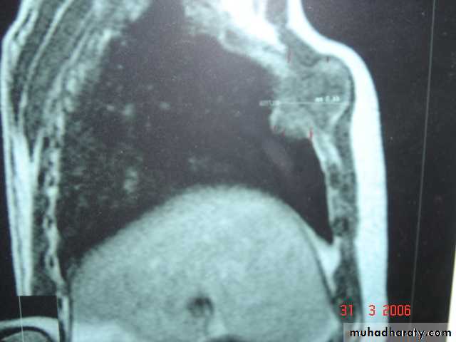 Trachea and bronchi