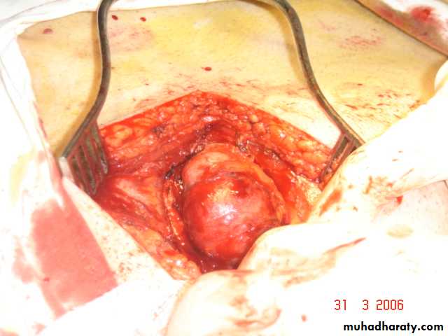 Trachea and bronchi