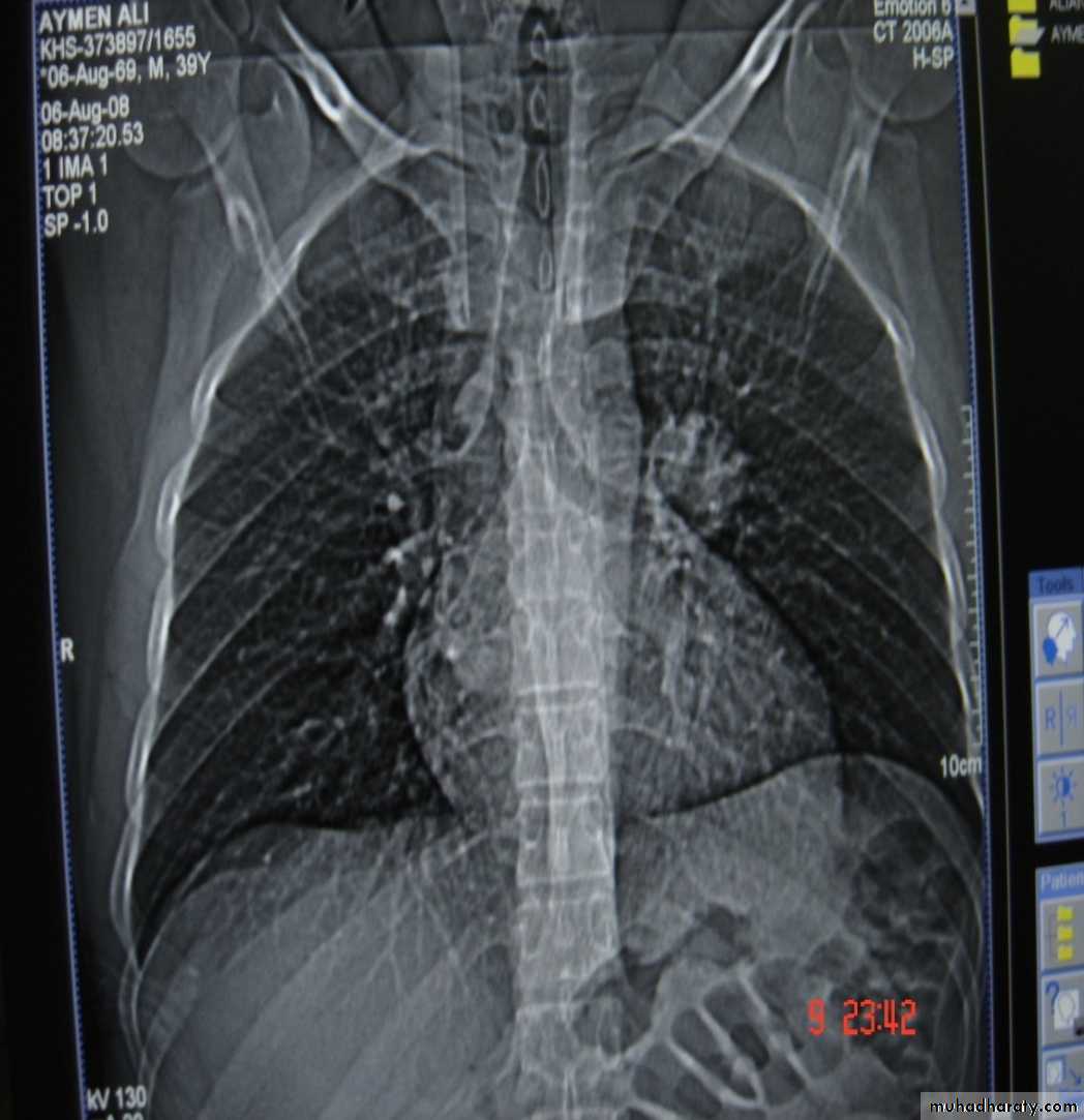Trachea and bronchi