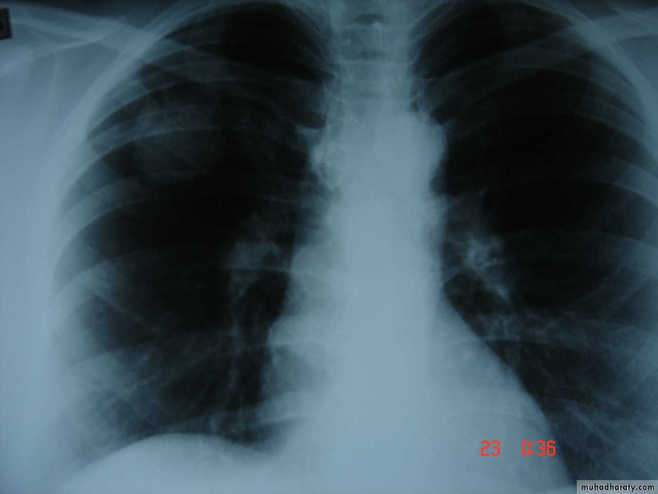 Trachea and bronchi