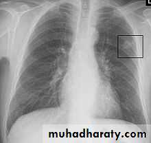 DDx of solitary lung lesion including lung abscess and Hydatid cyst and Tb