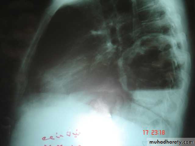 DDx of solitary lung lesion including lung abscess and Hydatid cyst and Tb