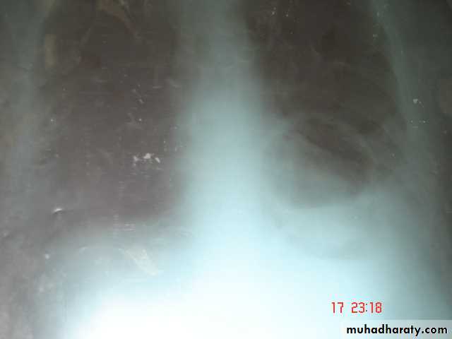DDx of solitary lung lesion including lung abscess and Hydatid cyst and Tb