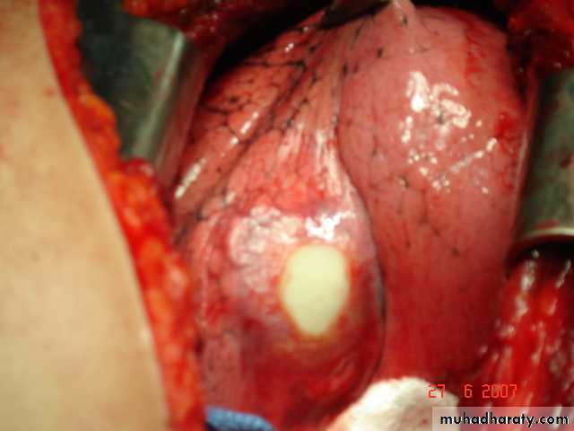DDx of solitary lung lesion including lung abscess and Hydatid cyst and Tb
