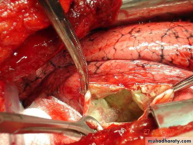 DDx of solitary lung lesion including lung abscess and Hydatid cyst and Tb
