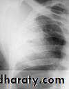 DDx of solitary lung lesion including lung abscess and Hydatid cyst and Tb
