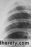 DDx of solitary lung lesion including lung abscess and Hydatid cyst and Tb