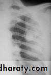DDx of solitary lung lesion including lung abscess and Hydatid cyst and Tb