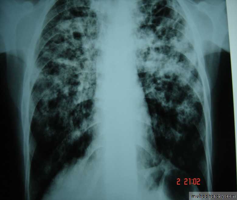 DDx of solitary lung lesion including lung abscess and Hydatid cyst and Tb