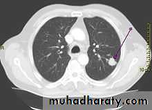 DDx of solitary lung lesion including lung abscess and Hydatid cyst and Tb