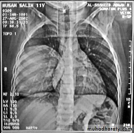DDx of solitary lung lesion including lung abscess and Hydatid cyst and Tb