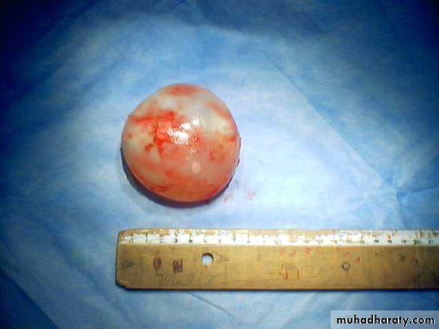 DDx of solitary lung lesion including lung abscess and Hydatid cyst and Tb