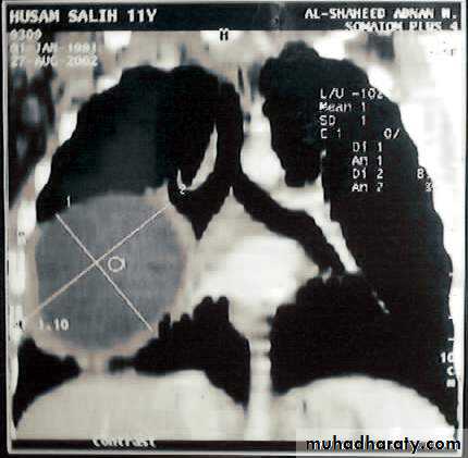 DDx of solitary lung lesion including lung abscess and Hydatid cyst and Tb