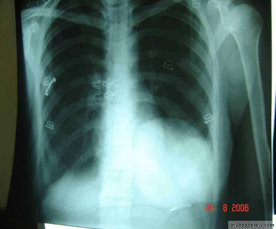 DDx of solitary lung lesion including lung abscess and Hydatid cyst and Tb