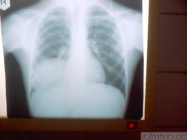 DDx of solitary lung lesion including lung abscess and Hydatid cyst and Tb