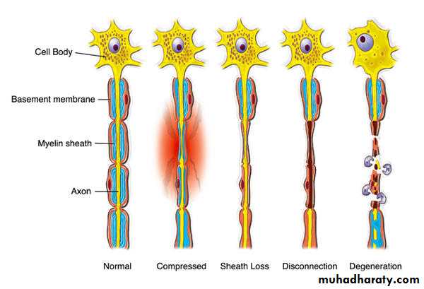 Peripheral nerve disease PNP
