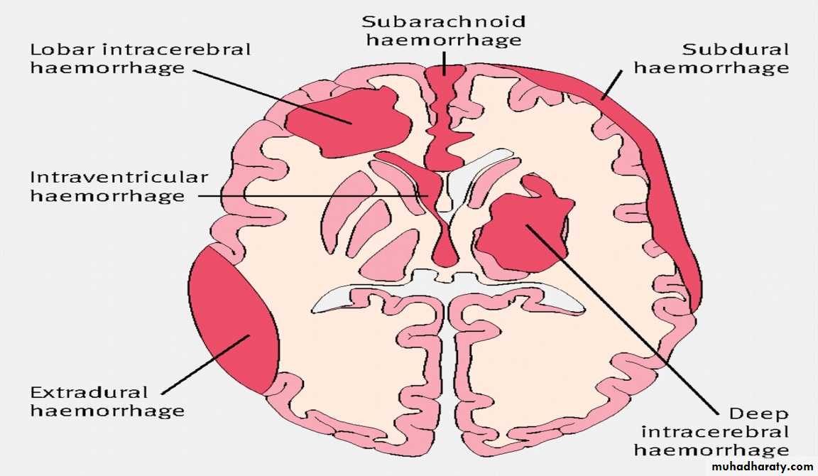 Intracranial hemorrhage